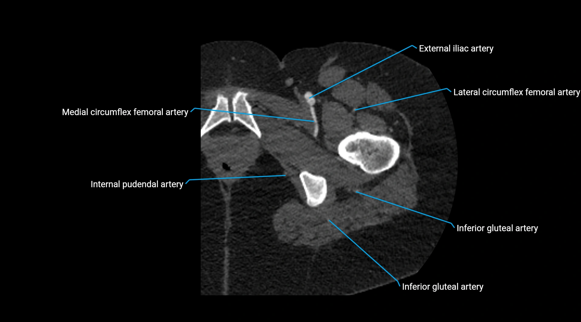 CTA lower limb cross sectional anatomy labelled image _67.webp